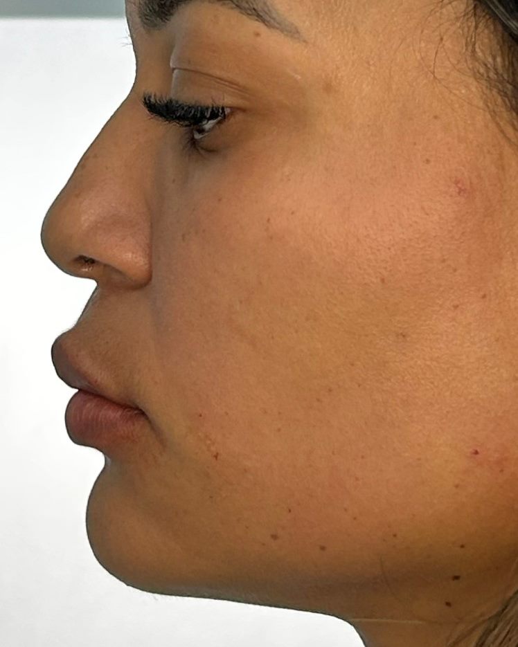Perfil de paciente após perfiloplastia