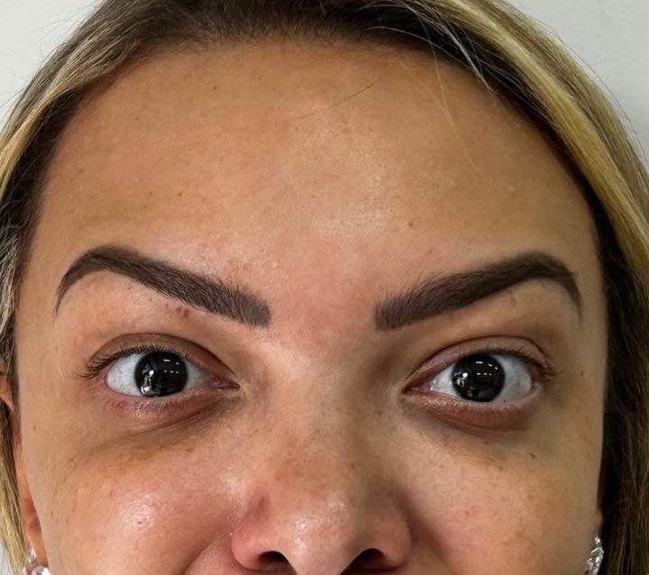 Testa de paciente após toxina botulínica